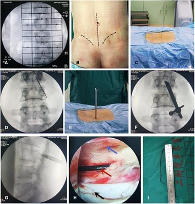 Percutaneous fully endoscopic surgical management of the ruptured epidural catheter: Rescue of the novice anesthesiologist from his dilemma